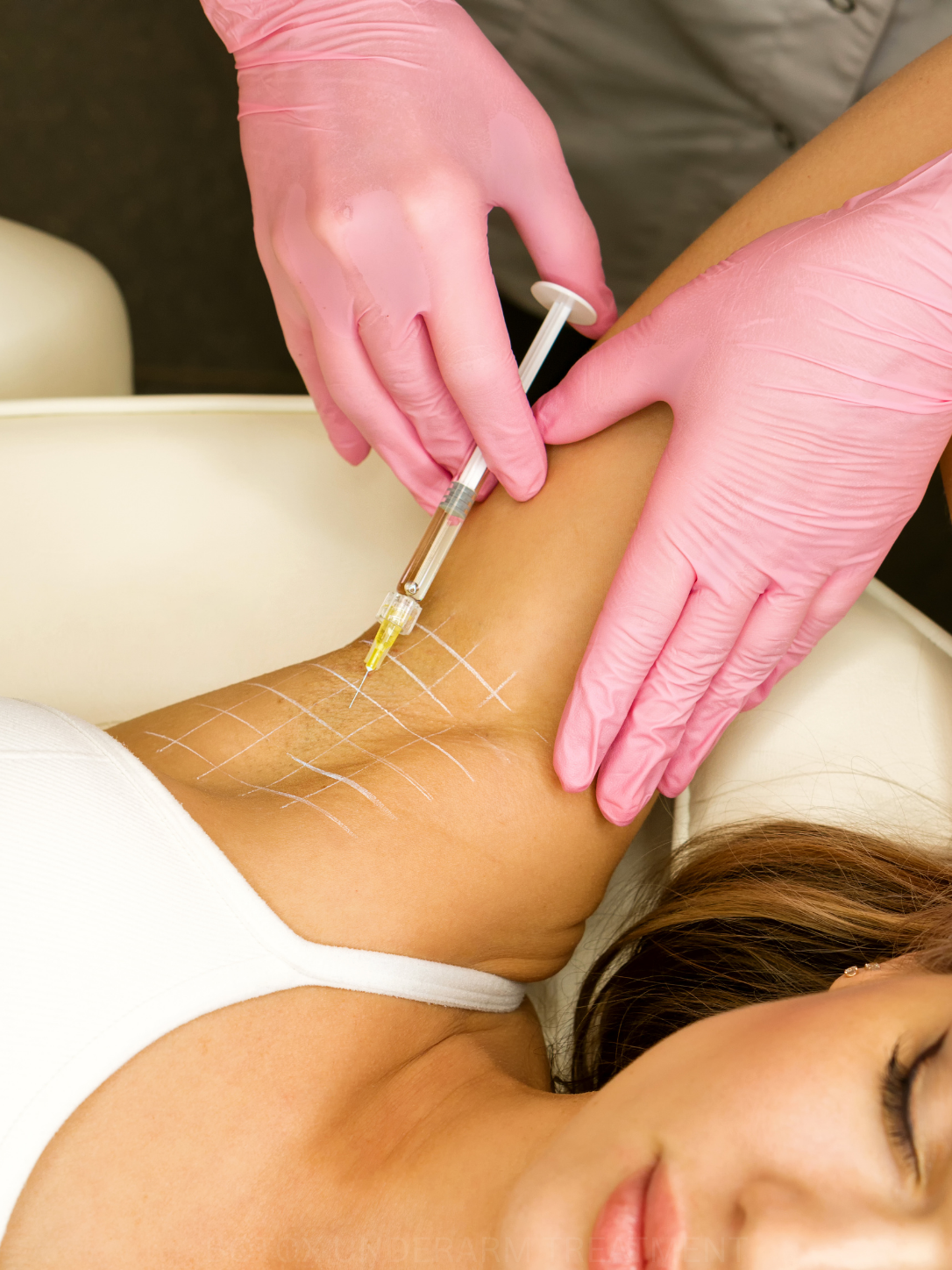 Neurotoxin injection for hyperhidrosis treatment
